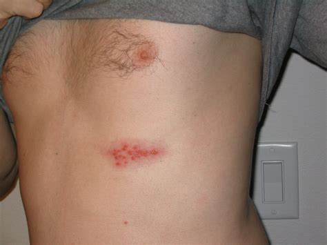 Shingles (Herpes Zoster) 